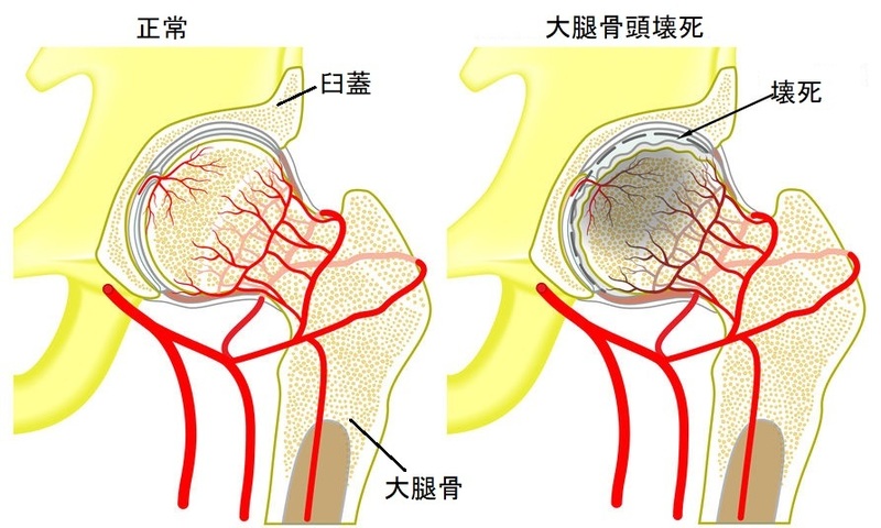 大腿骨頭壊死の図解
