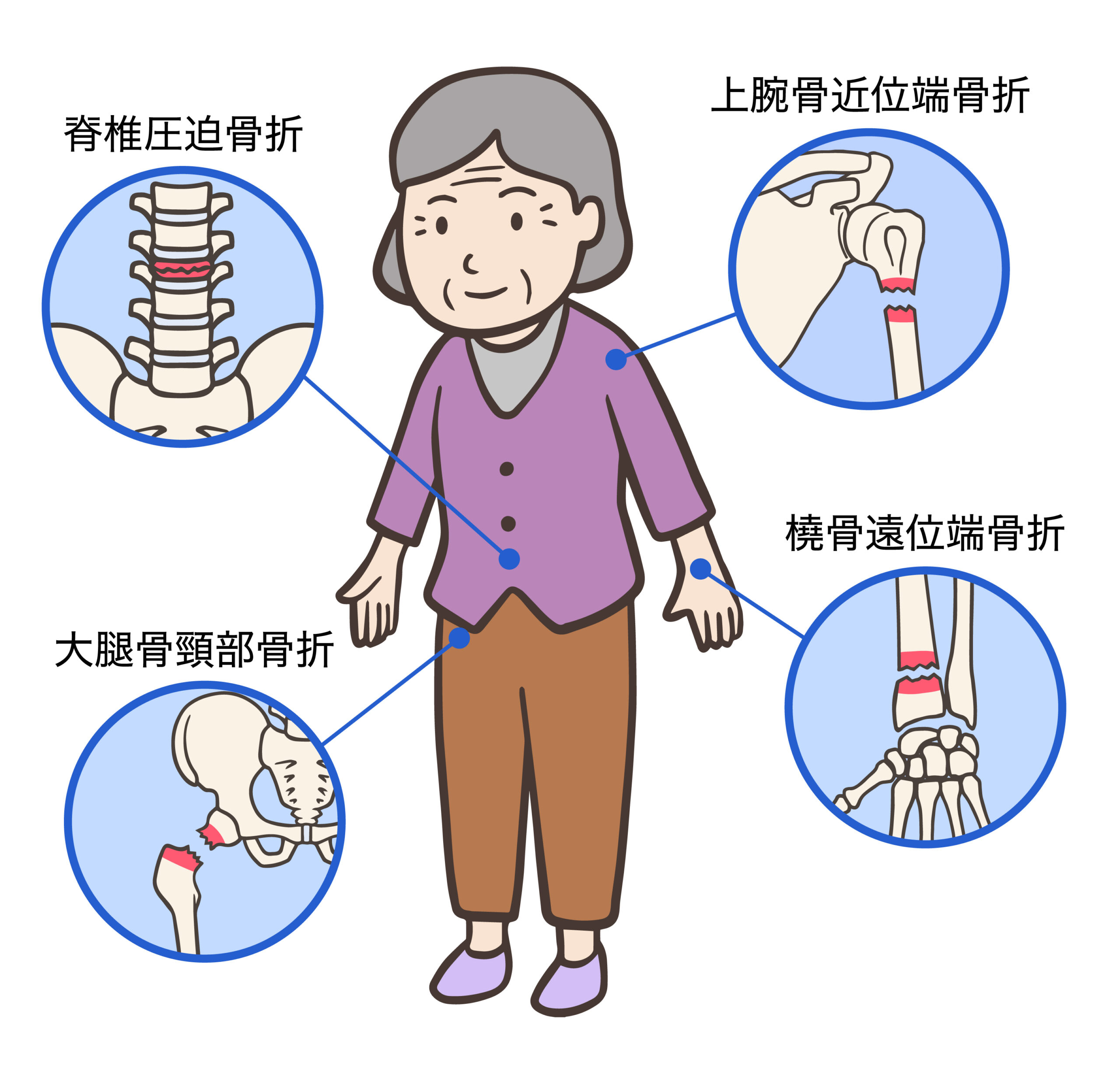高齢者に多い4大骨折
