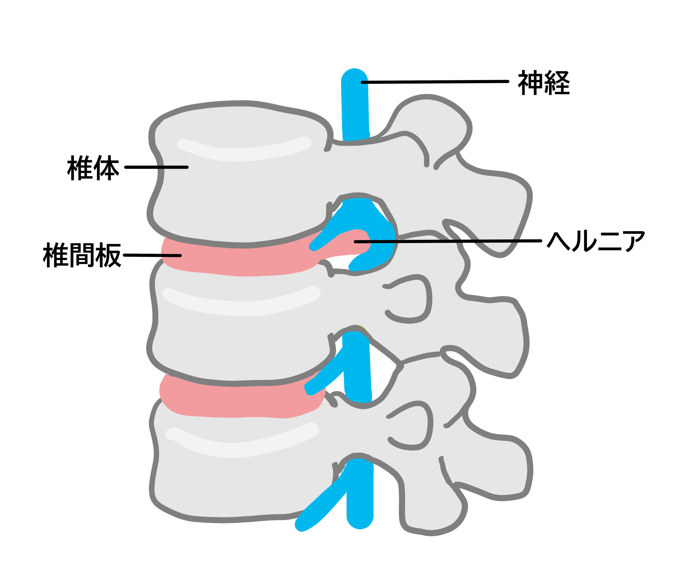 椎間板ヘルニアのイラスト